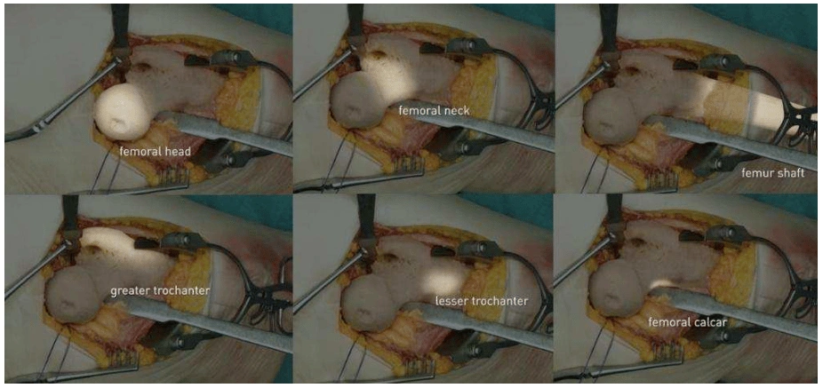 Highlights of the anatomy of the hip during total hip surgery